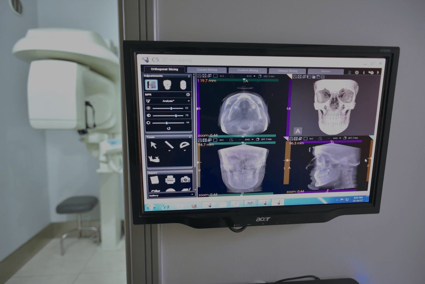Cone Beam CT Scan