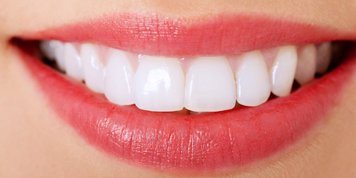 Porcelain Veneers smile with pink lips