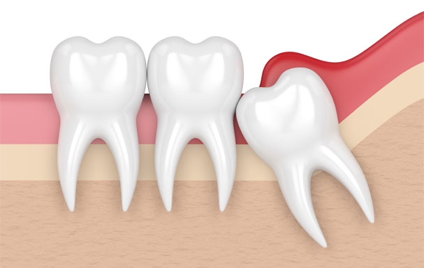 wisdom teeth