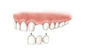 dental bridge