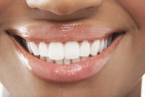 Teeth Whitening