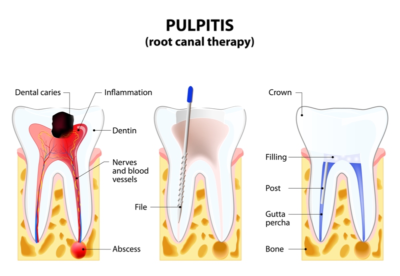 Process of a root canal treatment
