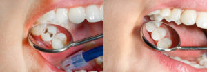 tooth colored fillings