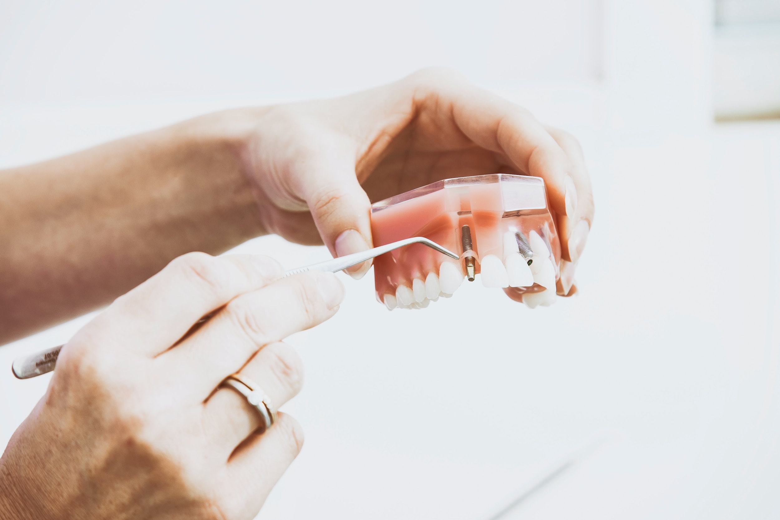 hand pointing to abutment on fake teeth