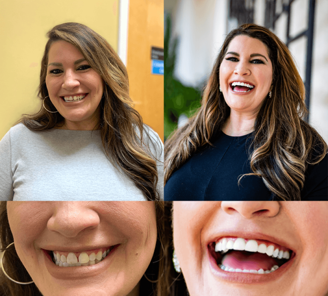 before and after cosmetic dentistry case