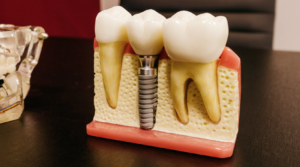 dental implants