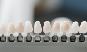 veneers